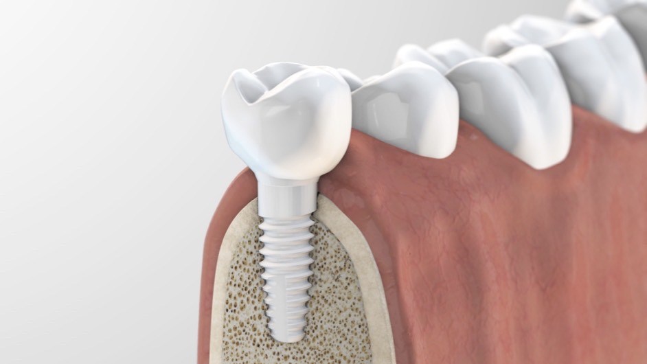 Foto: Keramikimplantate ZERAMEX®